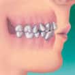 牙齒擁擠和齒顎矯正 - 高露潔台灣
