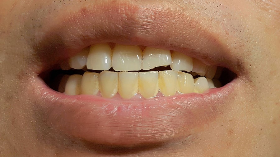 牙結石的形成原因及預防方法 - 高露潔台灣