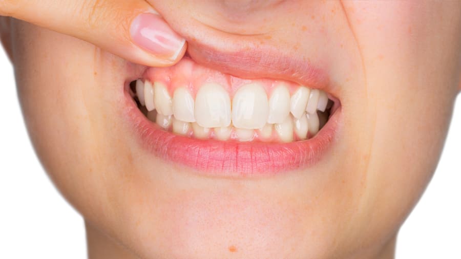 牙齦流血減緩方法及其他建議 - 高露潔台灣