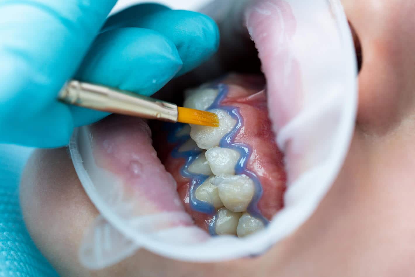 診所及居家牙齒美白方法 - 高露潔台灣