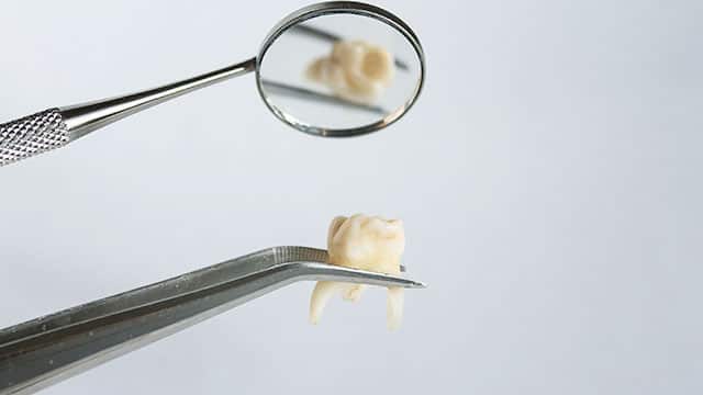 牙醫用鉗子拔出一顆蛀了的牙