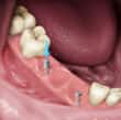 假牙過程 - 固定義齒 - 高露潔台灣