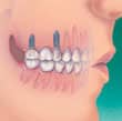 植牙流程 - 植體可作為各替換齒的基底 - 高露潔台灣