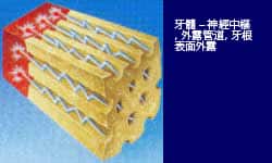 外露管道伸延至牙髓