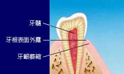 牙齦萎縮